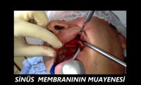 dis-kisti-ameliyati-implant-tedavisi-cene-kisti-ameliyati-kapali-sinus-lifting-izle-video