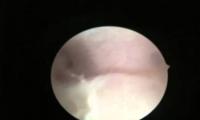 office-hysteroscopy-for-uterine-synechia-rahim-ici-yapisikliklarin-acilmasi