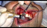 dental-implant-implant-ameliyati-bone-splitting-bone-spreading-izle-video