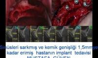 implant-dis-ameliyati-cene-kemigi-erimesi-tedavisi-kemik-grefti-ameliyati-izle-video