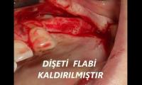 cene-kemigi-erimesi-tedavisi-sinus-lifting-bone-spreading-izle-video